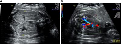 A novel PKHD1 splicing variant identified in a fetus with autosomal recessive polycystic kidney disease